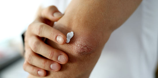 The New Must-Have Ingredient You Need in Eczema and Psoriasis Cream