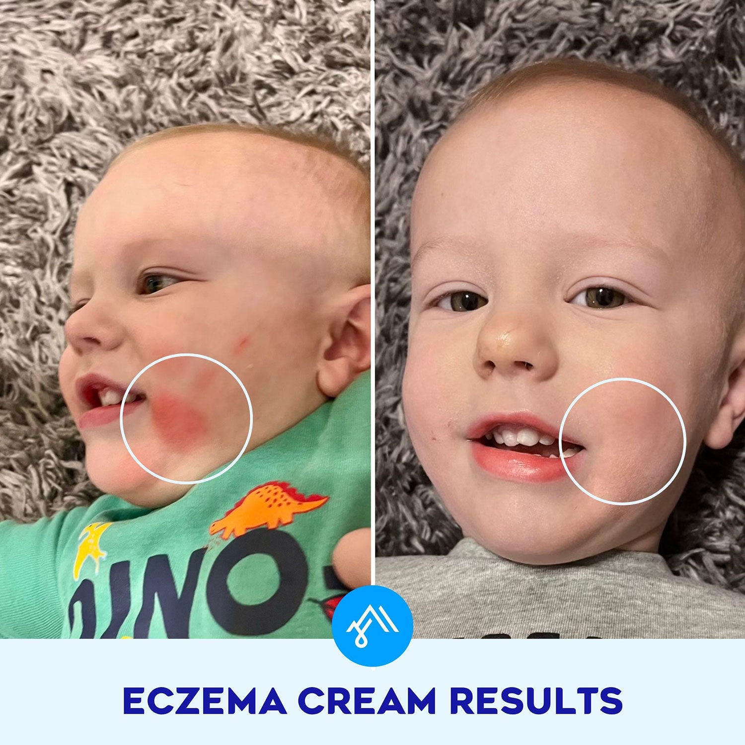 Eczema Cream with 1% Colloidal Oatmeal enhanced with Hydrosurf
