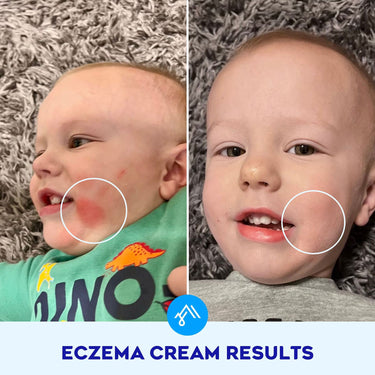 Eczema Cream with 1% Colloidal Oatmeal for Dry & Itchy Skin Relief ...