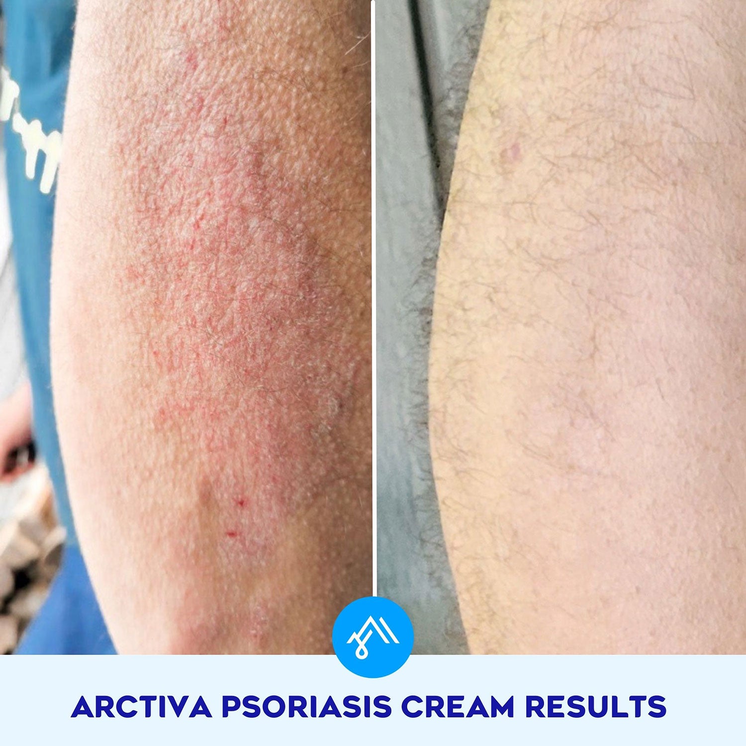 Psoriasis Cream with 2% Salicylic Acid enhanced with Hydrosurf